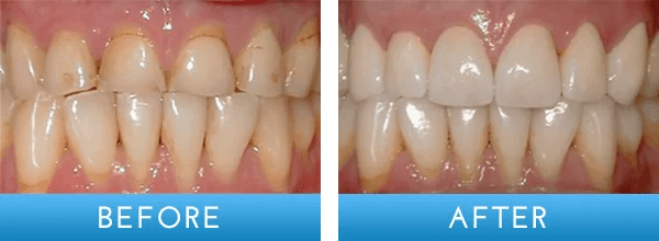Before and after dental treatment at A Shop for Smiles